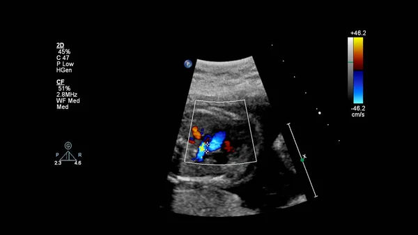 Ecrã Ultrassonográfico Com Ecocardiografia Fetal — Fotografia de Stock