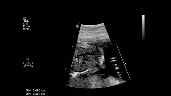 Ecrã Ultrassonográfico Com Ecocardiografia Fetal — Fotografia de Stock