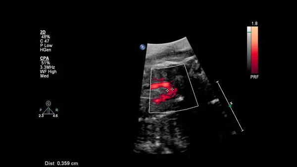 Ecrã Ultrassonográfico Com Ecocardiografia Fetal — Fotografia de Stock