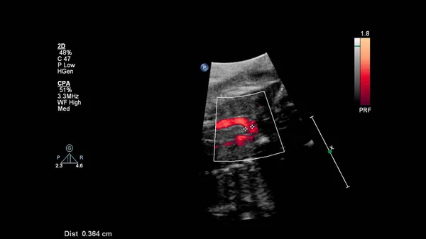 Ecrã Ultrassonográfico Com Ecocardiografia Fetal — Fotografia de Stock