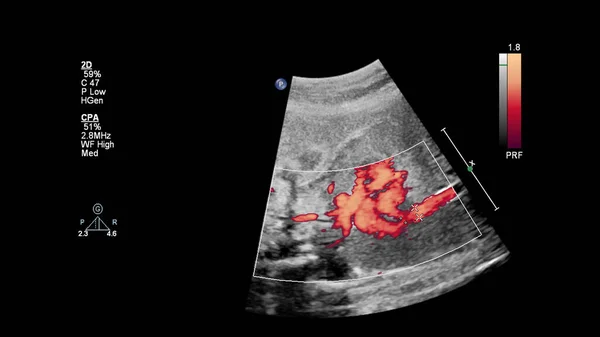 Ecrã Ultrassonográfico Com Ecocardiografia Fetal — Fotografia de Stock