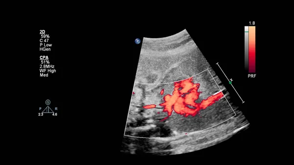 Echografie Scherm Met Foetale Echocardiografie — Stockfoto