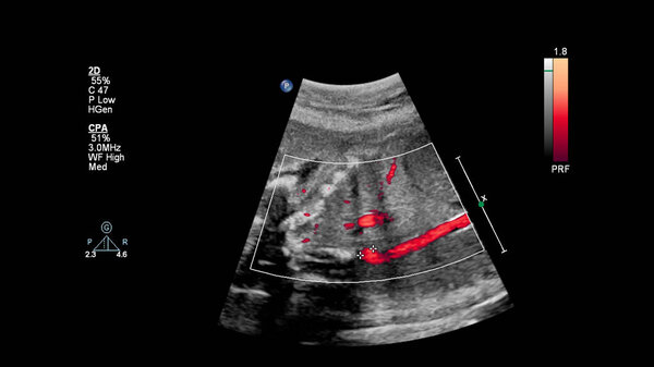 УЗИ с эхокардиографией плода
.