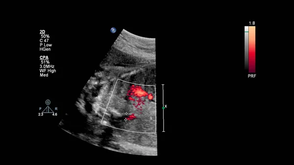 Ecrã Ultrassonográfico Com Ecocardiografia Fetal — Fotografia de Stock