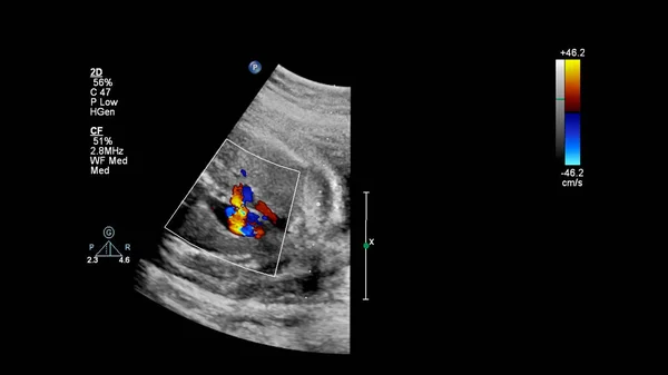 Ecrã Ultrassonográfico Com Ecocardiografia Fetal — Fotografia de Stock