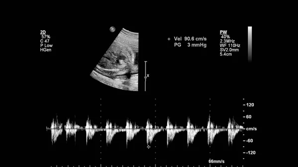 Ecrã Ultrassonográfico Com Ecocardiografia Fetal — Fotografia de Stock