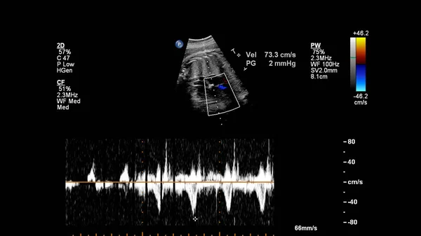 Fetal Ekokardiyografi Ile Ultrasonografi Ekranı — Stok fotoğraf