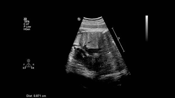 Ultrasound Screen Fetal Echocardiography — Stock Photo, Image