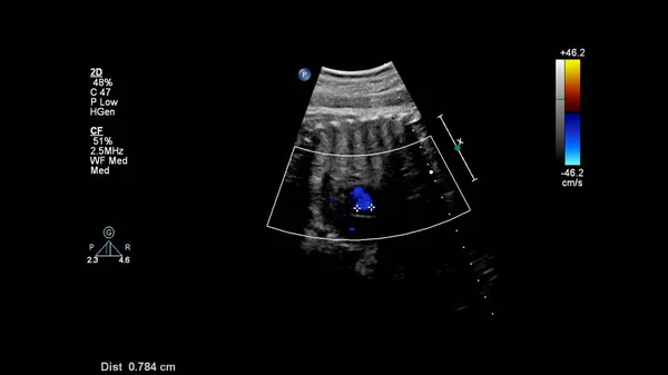 Ecrã Ultrassonográfico Com Ecocardiografia Fetal — Fotografia de Stock