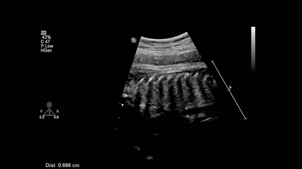 Ecrã Ultrassonográfico Com Ecocardiografia Fetal — Fotografia de Stock