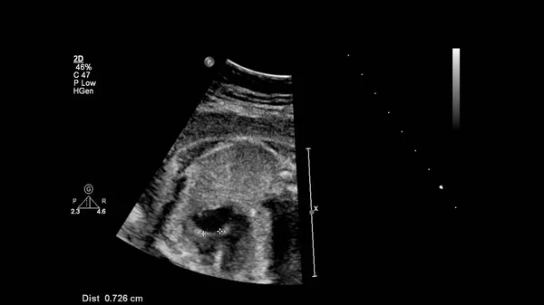 Echografie Scherm Met Foetale Echocardiografie — Stockfoto