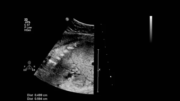 Echografie Scherm Met Foetale Echocardiografie — Stockfoto