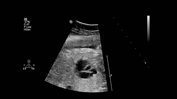 Ecrã Ultrassonográfico Com Ecocardiografia Fetal — Fotografia de Stock