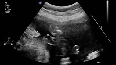 Kalbin ultrason transsofageal muayenesi.