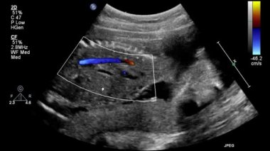 Kalbin ultrason transsofageal muayenesi.