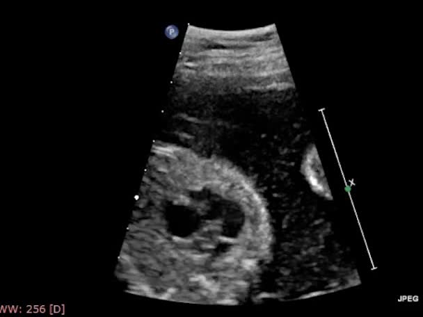 Echografie Transslokdarmonderzoek Van Het Hart — Stockvideo