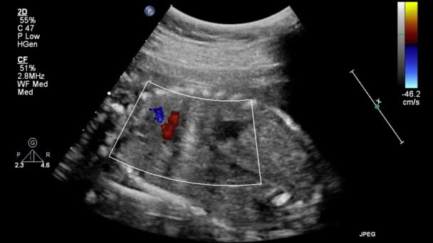 Echografie Transslokdarmonderzoek Van Het Hart — Stockvideo