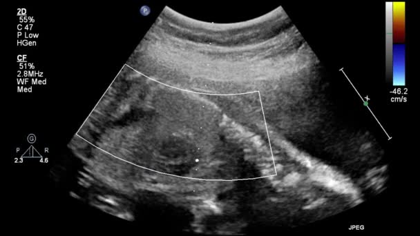 Echografie Transslokdarmonderzoek Van Het Hart — Stockvideo