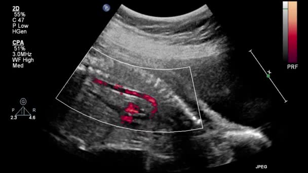 Ultraschall Transesophageale Untersuchung Des Herzens — Stockvideo