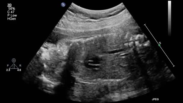 Ultrasound Transesophageal Examination Heart — Stock Video