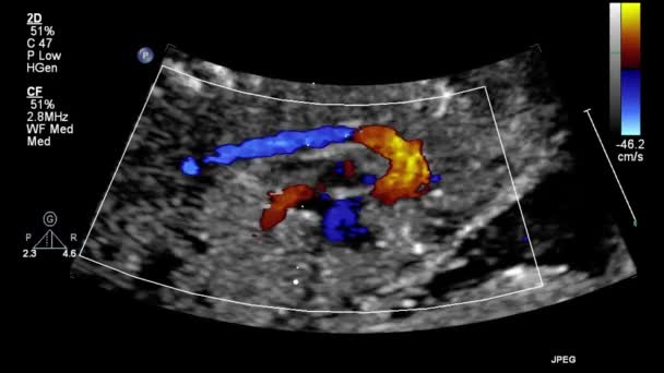 Ultrasound Transesophageal Examination Heart — Stock Video