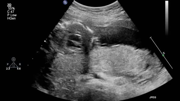 Ultrasound Transesophageal Examination Heart — Stock Video