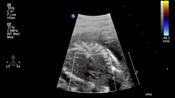 Ultraschall Transesophageale Untersuchung Des Herzens — Stockvideo