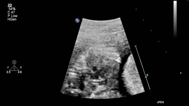 Kalbin Ultrason Transsofageal Muayenesi — Stok video