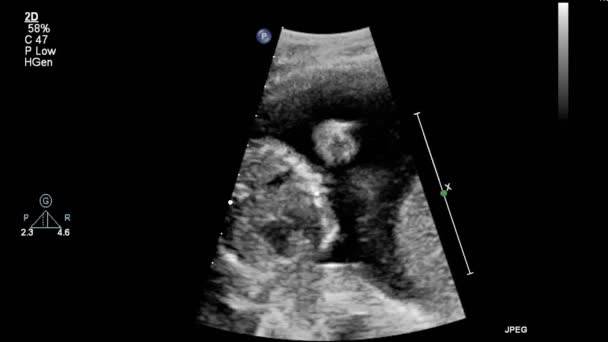 Ultrasound Transesophageal Examination Heart — Stock Video