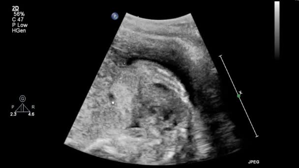 Ultrasound Transesophageal Examination Heart — Stock Video