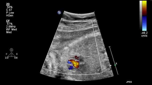 Ultraschall Transesophageale Untersuchung Des Herzens — Stockvideo