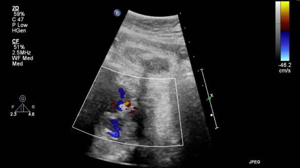 Ultrasound Transesophageal Examination Heart — Stock Video