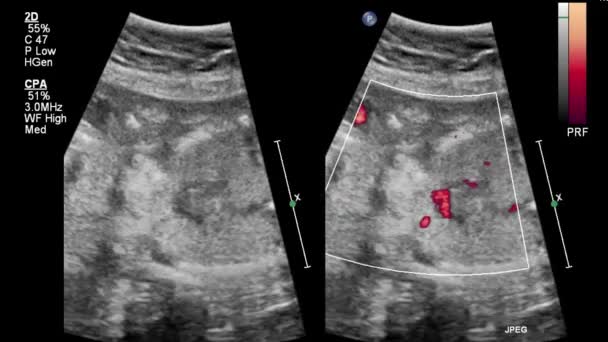 Ecografia Esame Transesofageo Del Cuore — Video Stock