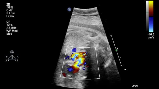 Echografie Transslokdarmonderzoek Van Het Hart — Stockvideo