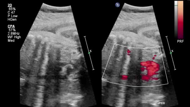 Υπερηχογράφημα Διοισοφαγική Εξέταση Της Καρδιάς — Αρχείο Βίντεο