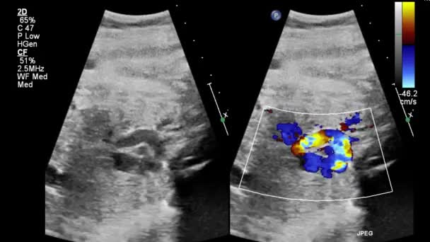 Echografie Transslokdarmonderzoek Van Het Hart — Stockvideo