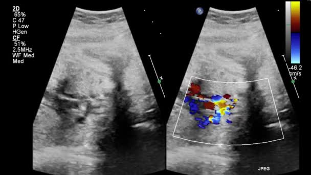 Echografie Transslokdarmonderzoek Van Het Hart — Stockvideo