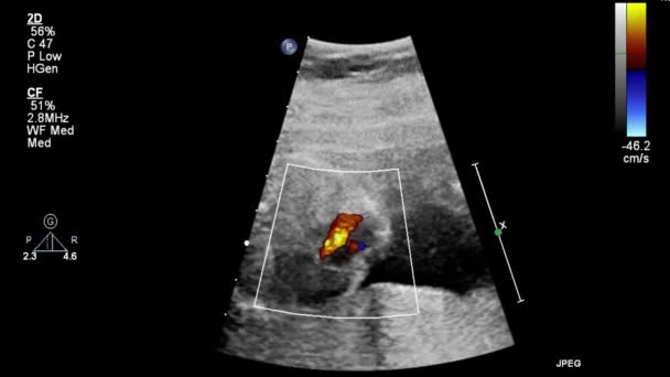 Ultraschall Transesophageale Untersuchung Des Herzens — Stockvideo