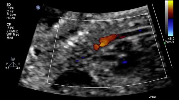 Ultrasound Transesophageal Examination Heart — Stock Video