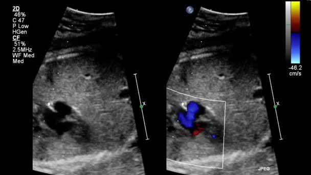 Ultrasound Transesophageal Examination Heart — Stock Video