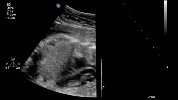 Ecografía Examen Transesofágico Del Corazón — Vídeos de Stock