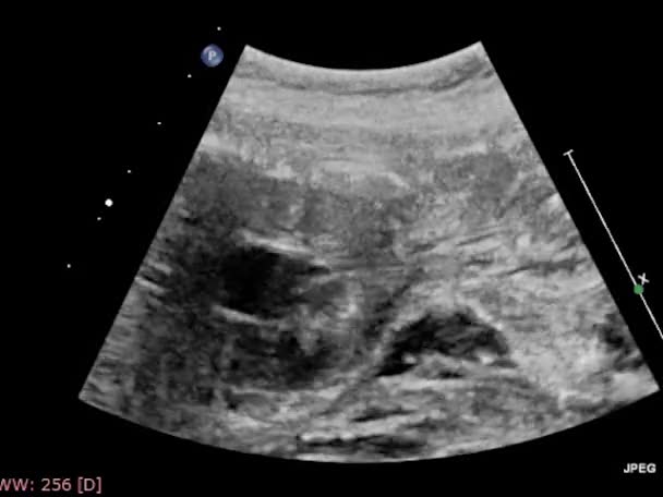 초음파 식도를 — 비디오