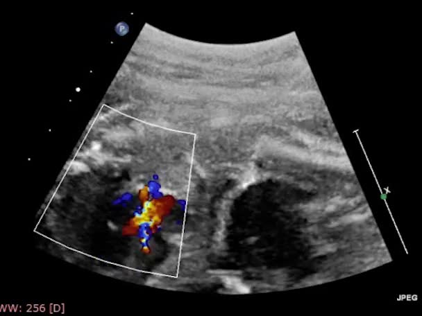 Ecografia Esame Transesofageo Del Cuore — Video Stock