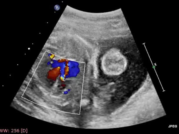 Ultrasound Transesophageal Examination Heart — Stock Video