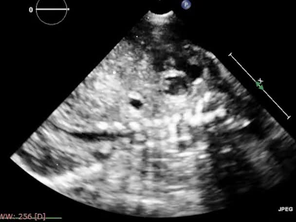Exame Transesofágico Ultrassonográfico Coração — Vídeo de Stock