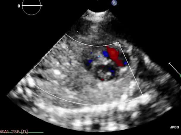 Ультразвуковое Трансофагеальное Исследование Сердца — стоковое видео