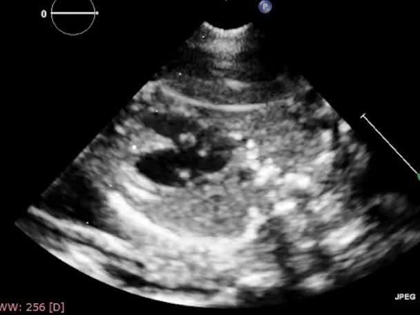 Ultrasound Transesophageal Examination Heart — Stock Video