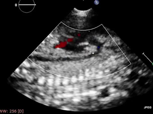 Echografie Transslokdarmonderzoek Van Het Hart — Stockvideo