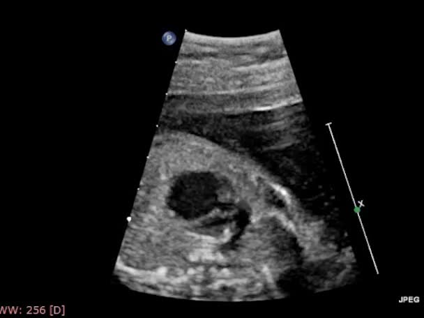 Echografie Transslokdarmonderzoek Van Het Hart — Stockvideo