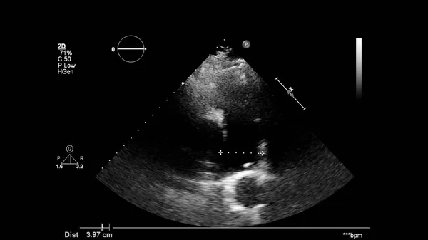 Image Cœur Mode Gris Lors Une Échographie Transœsophagienne — Photo